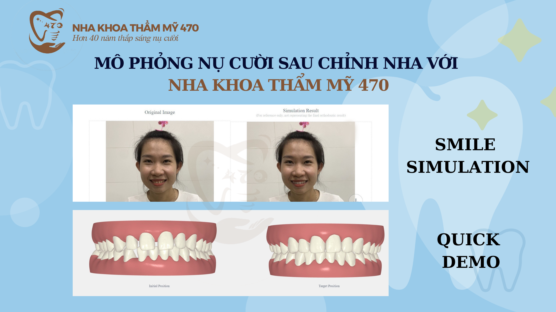 Hình ảnh niềng răng Invisalign trước và sau của khách hàng