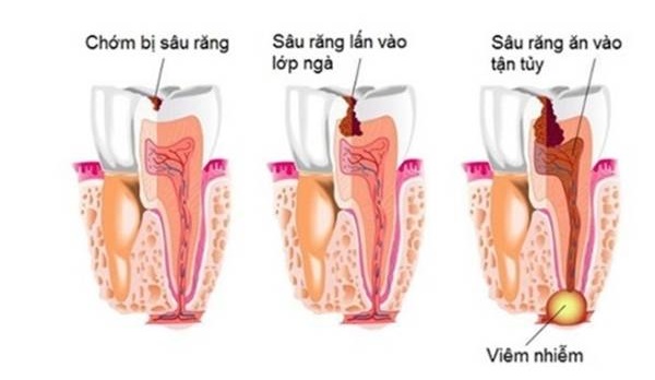 Quá trình sâu răng gây tổn hại đến tủy răng bên trong