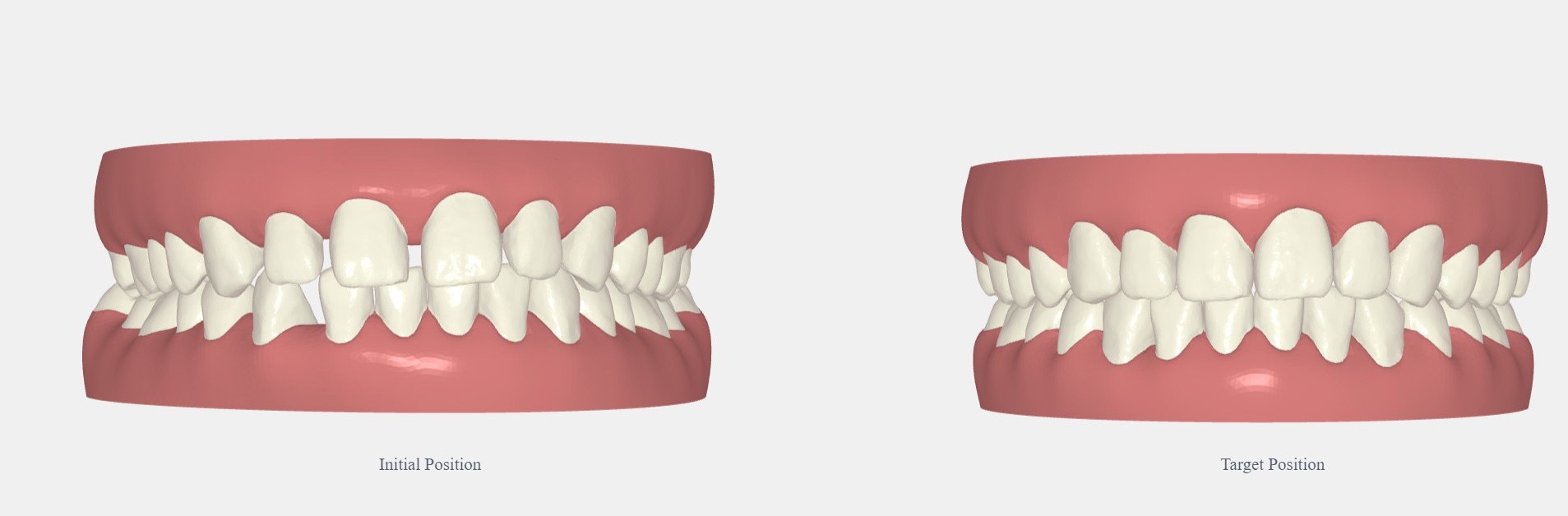 Ưu điểm vượt trội của phương pháp chỉnh nha Invisalign