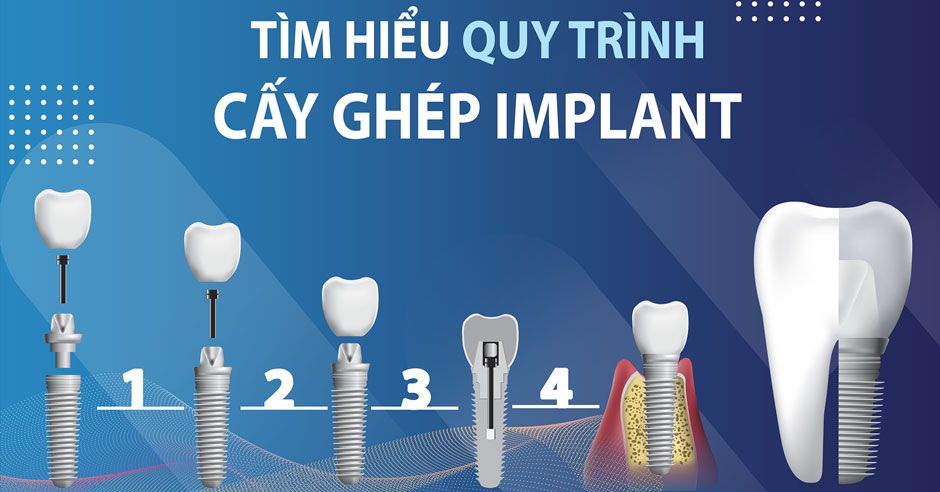 nha khoa thẩm mỹ 470 quận 3 - nơi được nhiều người tin tưởng và lựa chọn cho việc trồng răng implant