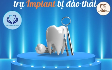Dấu hiệu chứng tỏ trụ Implant bị đào thải