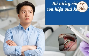 Niềng răng ở tuổi 30 liệu có hiệu quả?