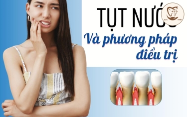 Các phương pháp điều trị tụt nướu