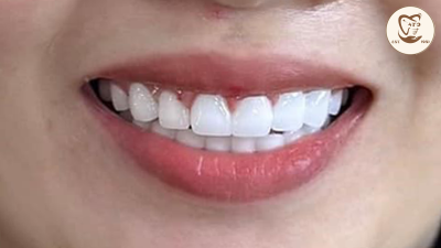 B&A Răng Sứ Cao Cấp