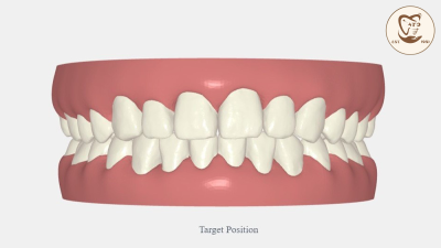 B&A Niềng Răng Trong Suốt Invisalign