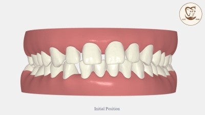 B&A Niềng Răng Trong Suốt Invisalign