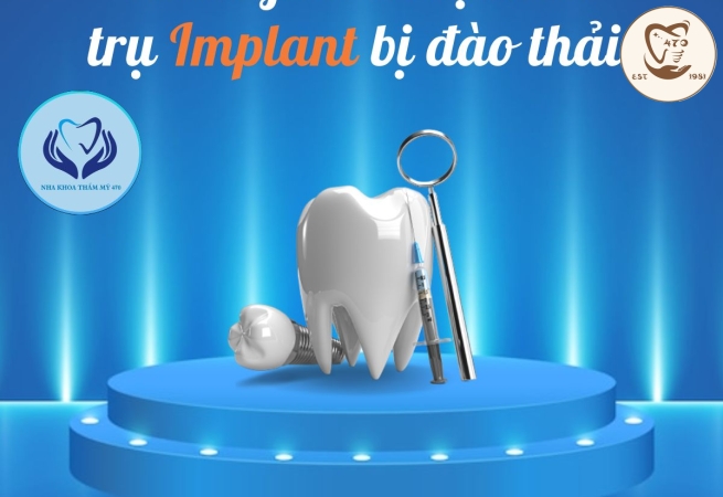 Dấu hiệu chứng tỏ trụ Implant bị đào thải