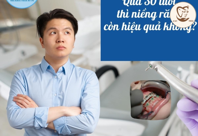 Niềng răng ở tuổi 30 liệu có hiệu quả?